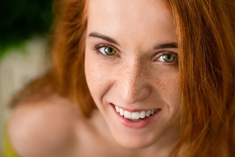 Natural Remedies to Fade Freckles at Home